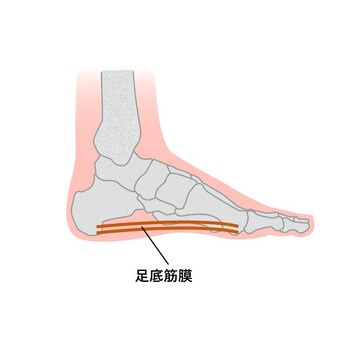 足底筋膜炎