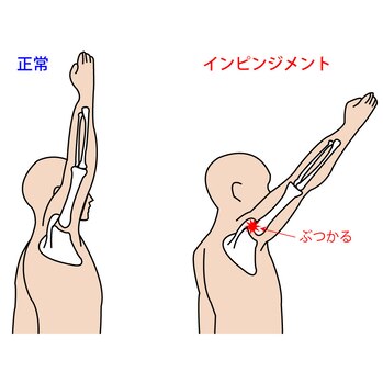 肩関節インピンジメント症候群（Shoulder Impingement Syndrome）