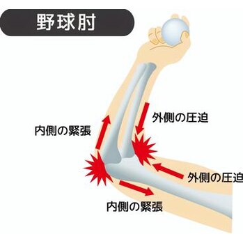 「野球肘」