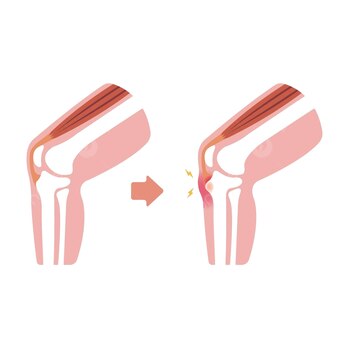 オスグッド・シュラッター